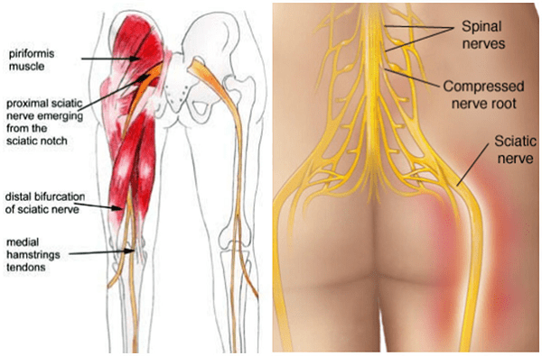 Đau thần kinh tọa là nguyên nhân gây ra đau mông Đau thần kinh tọa là nguyên nhân gây ra đau mông