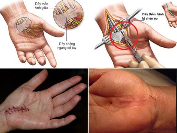 Biện pháp phẫu thuật hội chứng ống cổ tay Biện pháp phẫu thuật hội chứng ống cổ tay