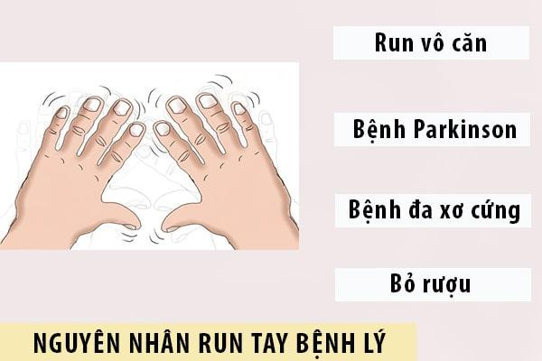 Nguyên nhân gây ra tình trạng run tay bệnh lý Nguyên nhân gây ra tình trạng run tay bệnh lý
