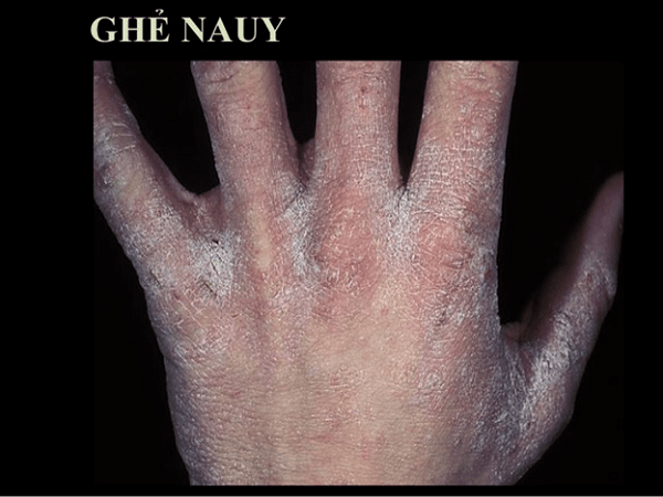 Dấu hiệu và triệu chứng của bệnh ghẻ Dấu hiệu và triệu chứng của bệnh ghẻ