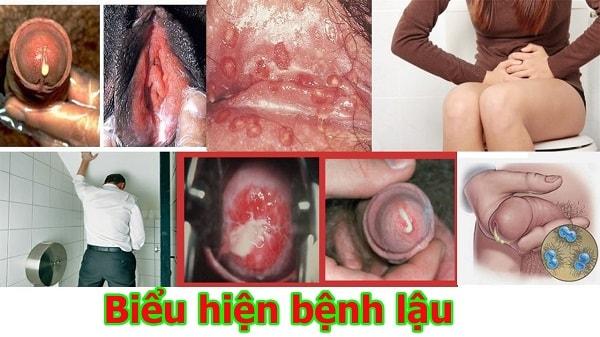 Dấu hiệu và triệu chứng của bệnh lậu Dấu hiệu, biểu hiện và triệu chứng của bệnh lậu