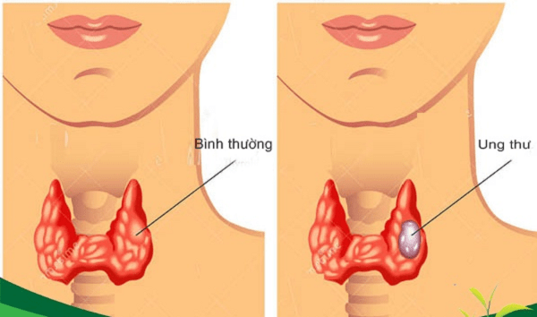 Điều trị bướu cổ ác tính Các phương pháp điều trị bệnh bướu cổ ác tính