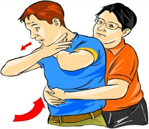 Phương pháp sơ cứu Heimlich 5 lần Phương pháp sơ cứu Heimlich 5 lần