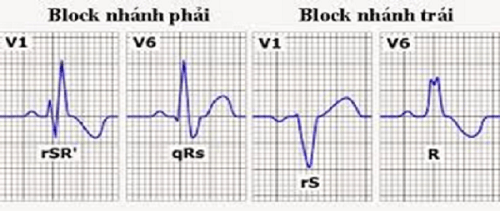 Block nhánh trái và phải