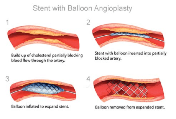 Điều trị bệnh bóc tách mạch vành tự phát bằng cách đặt stent Điều trị bệnh bóc tách mạch vành tự phát bằng cách đặt stent