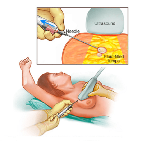 Điều trị bệnh bướu sợi tuyền Điều trị bệnh bướu sợi tuyền
