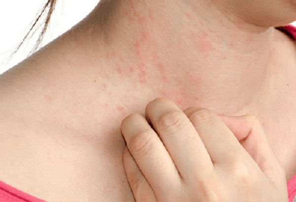 Dấu hiệu, biểu hiện và triệu chứng bệnh chàm eczema Dấu hiệu, biểu hiện và triệu chứng bệnh chàm eczema