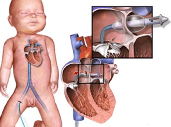 Điều trị bệnh chuyển vị đại động mạch Điều trị bệnh chuyển vị đại động mạch