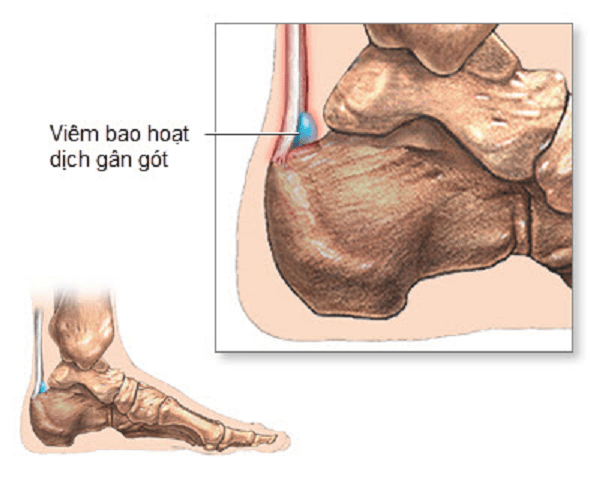 Viêm bao hoạt dịch - nguyên nhân đau gót chân
