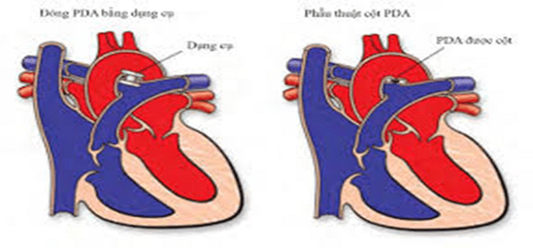Điều trị bệnh còn ống động mạch Điều trị bệnh còn ống động mạch