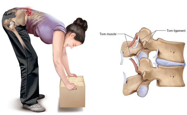 Nguyên nhân gây ra đau thắt lưng Nguyên nhân gây ra đau thắt lưng