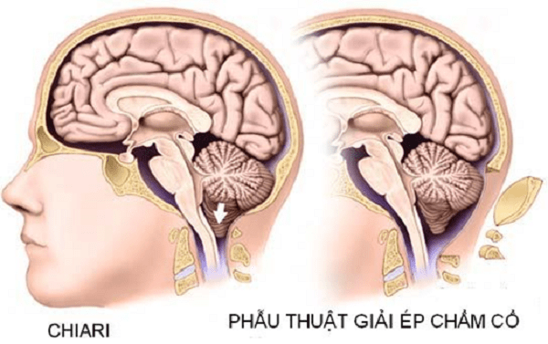 Điều trị bệnh dị dạng Chiari Điều trị bệnh dị dạng Chiari