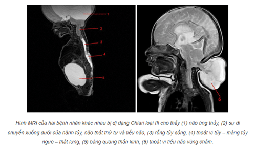 Triệu chứng của dị dạng chiari loại III Triệu chứng của dị dạng chiari loại III