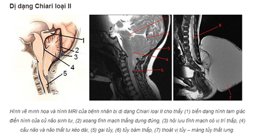 Triệu chứng của dị dạng chiari loại II Triệu chứng của dị dạng chiari loại II