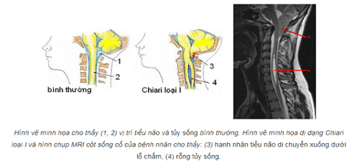 Triệu chứng của dị dạng chiari loại I Triệu chứng của dị dạng chiari loại I