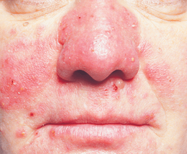 Rhinophyma (mũi sư tử)