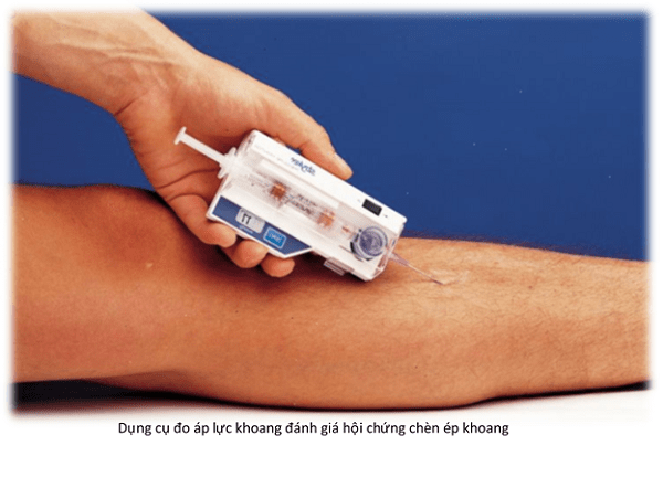 Dụng cụ đo áp lực khoang đánh giá hội chứng chèn ép khoang Dụng cụ đo áp lực khoang đánh giá hội chứng chèn ép khoang