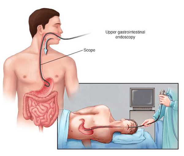 Điều trị bệnh giãn tĩnh mạch thực quản