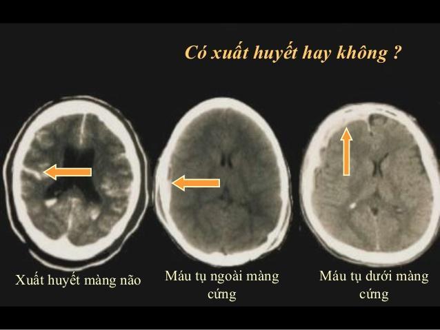 Hình ảnh tai biến mạch máu não Hình ảnh tai biến mạch máu não