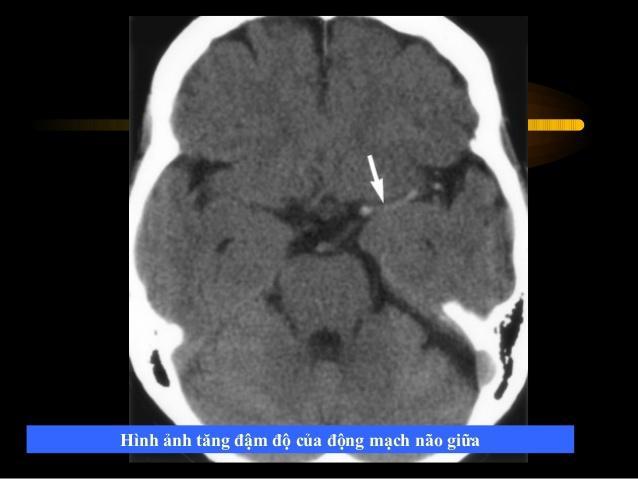 Hình ảnh tai biến mạch máu não Hình ảnh tai biến mạch máu não