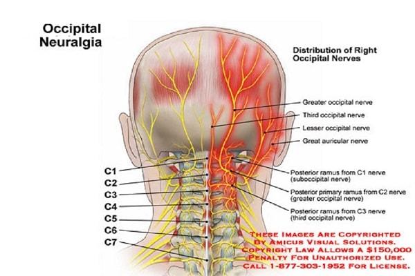 Nguyên nhân của bệnh đau dây thần kinh chẩm