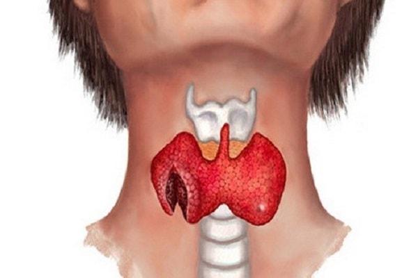 Nguyên nhân gây ra bệnh bướu cổ Nguyên nhân gây ra bệnh bướu cổ
