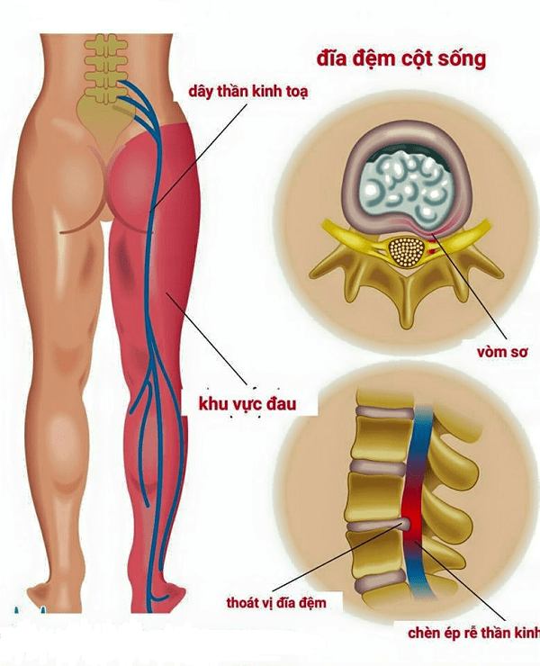 Nguyên nhân gây ra bệnh đau thần kinh tọa