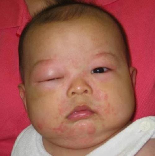 Triệu chứng bệnh phù mạch Dấu hiệu, biểu hiện và triệu chứng của bệnh phù mạch