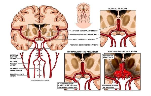Nguyên nhân gây ra bệnh phình mạch máu não Nguyên nhân gây ra bệnh phình mạch máu não