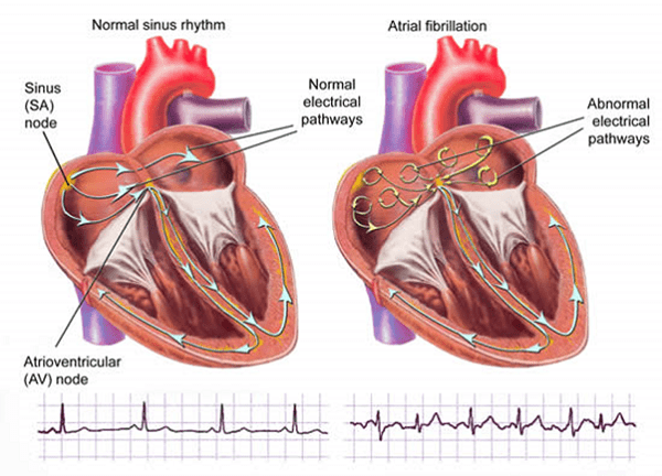 Nguyên nhân gây ra rối loạn nhịp tim