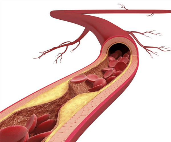 Nguyên nhân gây ra tình trạng tắc nghẽn động mạch chủ - chậu Nguyên nhân gây ra tình trạng tắc nghẽn động mạch chủ - chậu