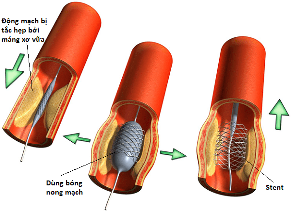 Phương pháp điều trị xâm lấn tối thiểu cho bệnh tắc nghẽn động mạch chủ - chậu Phương pháp điều trị xâm lấn tối thiểu cho bệnh tắc nghẽn động mạch chủ - chậu