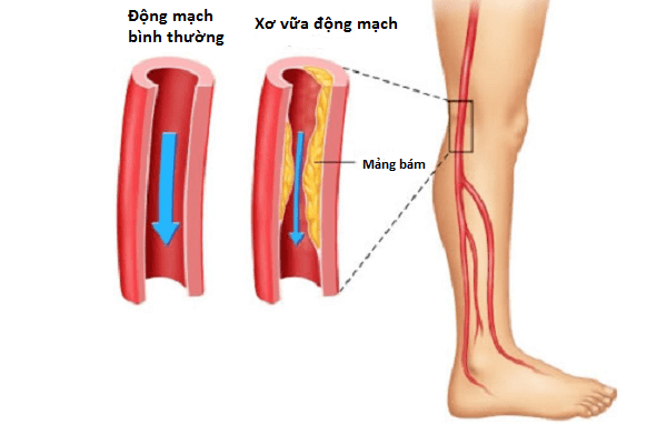 Nguyên nhân gây ra bệnh thiếu máu chi trầm trọng Nguyên nhân gây ra bệnh thiếu máu chi trầm trọng