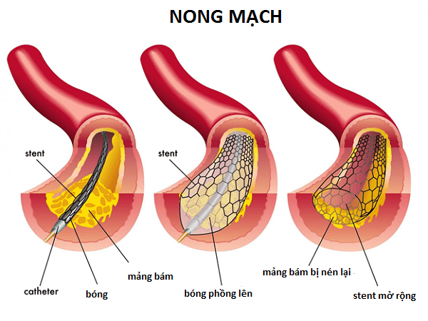Phương pháp điều trị nội mạch của bệnh thiếu máu chi trầm trọng Phương pháp điều trị nội mạch của bệnh thiếu máu chi trầm trọng