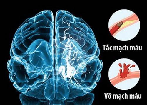 Tỷ lệ tai biến mạch máu não ở Việt Nam Tỷ lệ tai biến mạch máu não ở Việt Nam