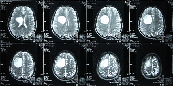 Chụp CT bẹnh nhân u não