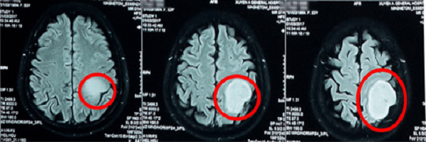 Chụp MRI bệnh nhân u não