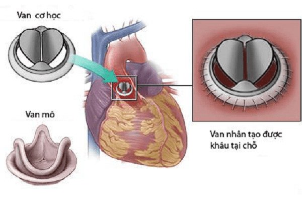 Điều trị bệnh van 2 lá