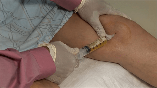 Điều trị bệnh viêm khớp Các phương pháp điều trị bệnh viêm khớp