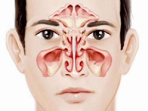 Nguyên nhân gây ra bệnh viêm xoang Nguyên nhân gây ra bệnh viêm xoang