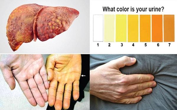 Dấu hiệu, biểu hiện và triệu chứng của bệnh xơ gan Dấu hiệu, biểu hiện và triệu chứng của bệnh xơ gan