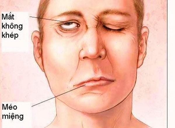Dấu hiệu, biểu hiện và triệu chứng cuả bệnh xuất huyết não - chảy máu não